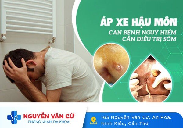 Dấu hiệu nhận biết và cách chữa áp xe hậu môn hiệu quả