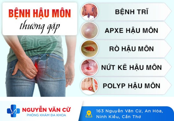 Phương pháp hỗ trợ điều trị sưng hậu môn tiên tiến hiện nay