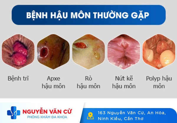 Những bệnh hậu môn thường gặp: nguyên nhân và cách chữa