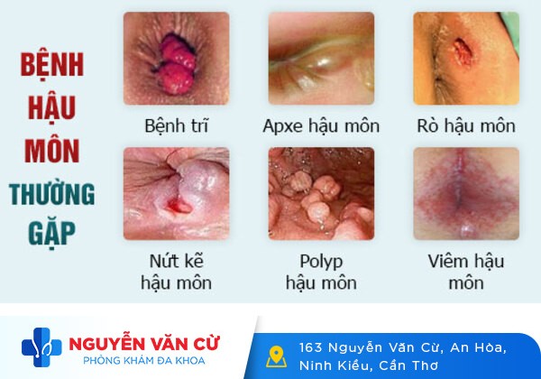 Dấu hiệu nhận biết bệnh hậu môn
