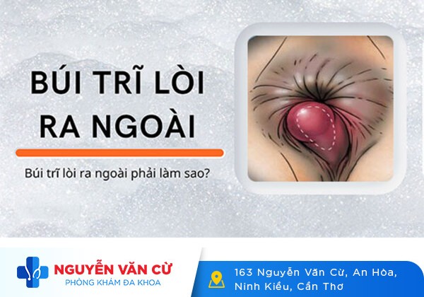 Lòi búi trĩ là gì và cách chữa bệnh trĩ lòi