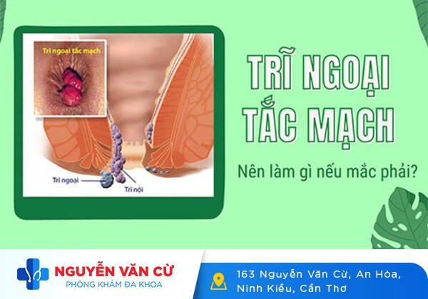 Trĩ Tắc Mạch Có Nguy Hiểm Không?
