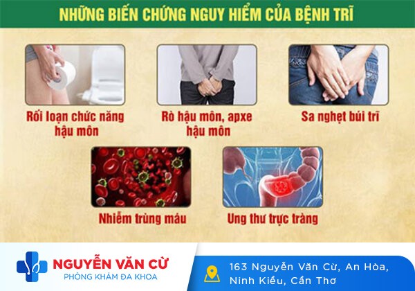 Chữa bệnh trĩ ở đâu hiệu quả tại Cần Thơ?