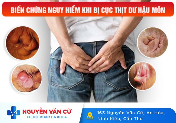 Cách cắt thịt thừa hậu môn an toàn, tiết kiệm, không lo tái phát
