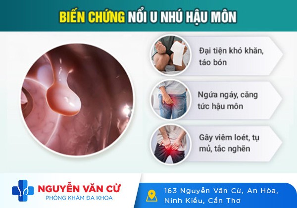 Khối U Ở Hậu Môn Là Triệu Chứng Của Bệnh Gì?