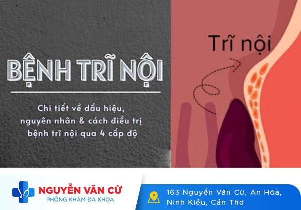 Những thông tin cần biết về bệnh trĩ nội độ 1, độ 2