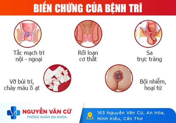 Cảnh Báo Tác Hại Từ Bệnh Trĩ