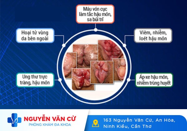 Bệnh Trĩ Ra Máu Và Những Biến Chứng Khôn Lường