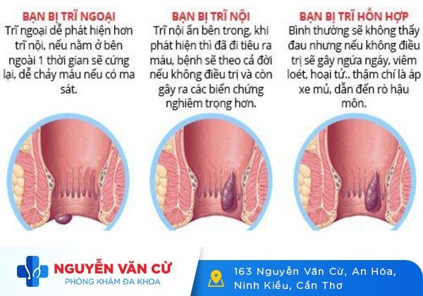 Chữa bệnh trĩ ở bệnh viện nào?