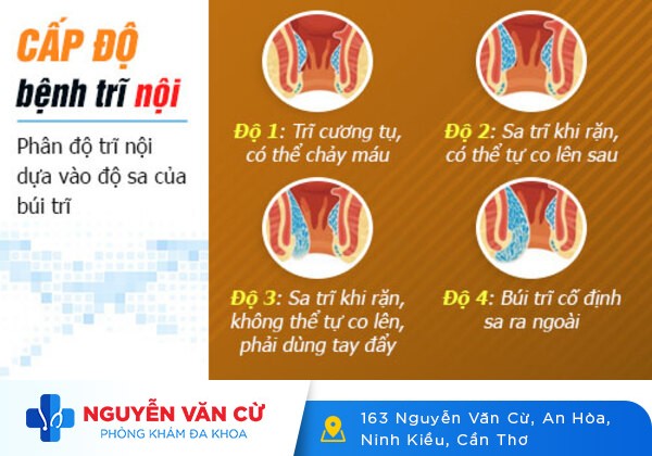 Bệnh trĩ nội và địa chỉ điều trị bệnh trĩ nội hiệu quả