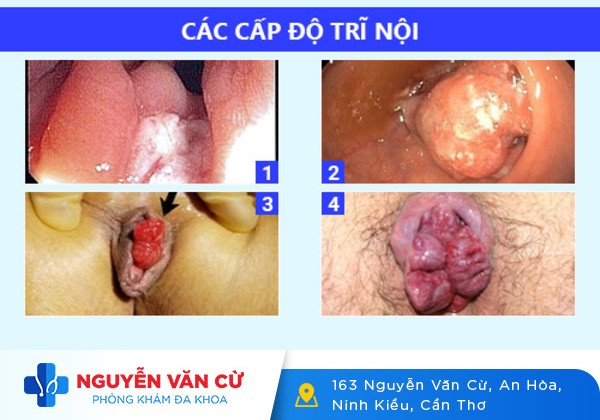 Bệnh trĩ nội có triệu chứng như thế nào?