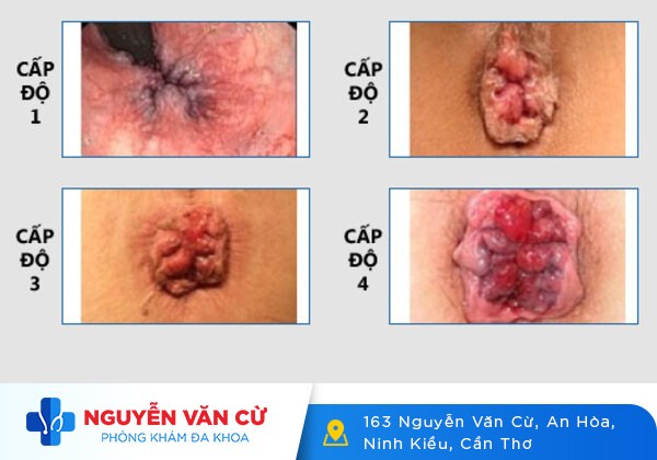 Điều trị bệnh lòi dom bằng cách nào?