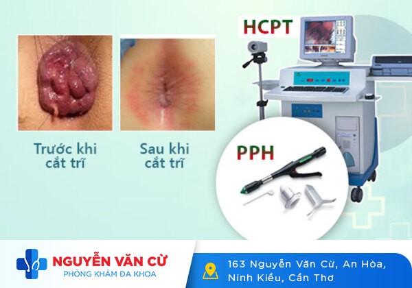 Cắt trĩ bằng phương pháp PPH, HCPT hiện đại và tiên tiến
