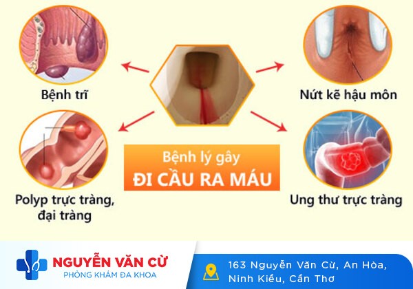 Ỉa Ra Máu Là Dấu Hiệu Của Bệnh Gì?