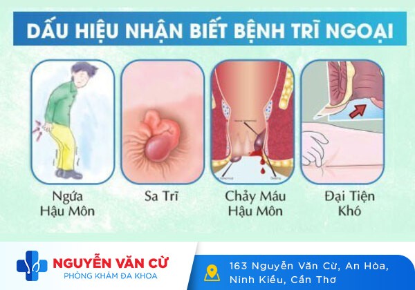 Cách chữa bệnh trĩ ngoại thực sự hiệu quả