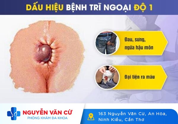 Bệnh trĩ ngoại độ 1, độ 2: cần chữa ngay để tránh biến chứng