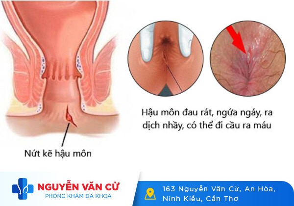 Nứt hậu môn là gì? Nhận biết dấu hiệu, nguyên nhân và cách điều trị