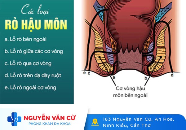Bệnh Mạch Lươn Và Phương Pháp Điều Trị Hiệu Quả