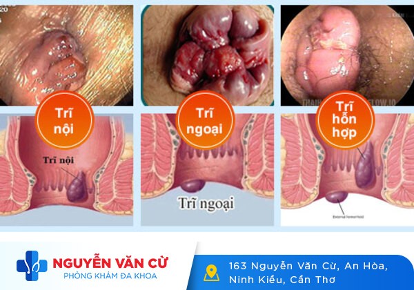 Bệnh trĩ là gì?