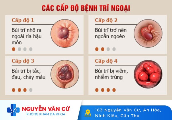 Bệnh trĩ ngoại và cách chữa an toàn