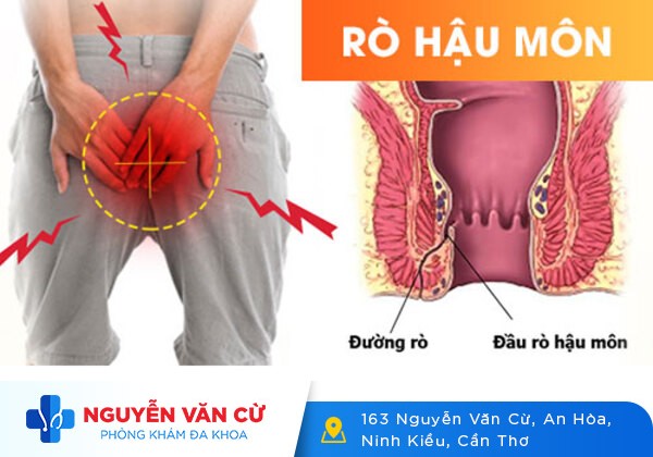 Bệnh Mạch Lươn Là Gì? Điều Trị Bằng Cách Nào?