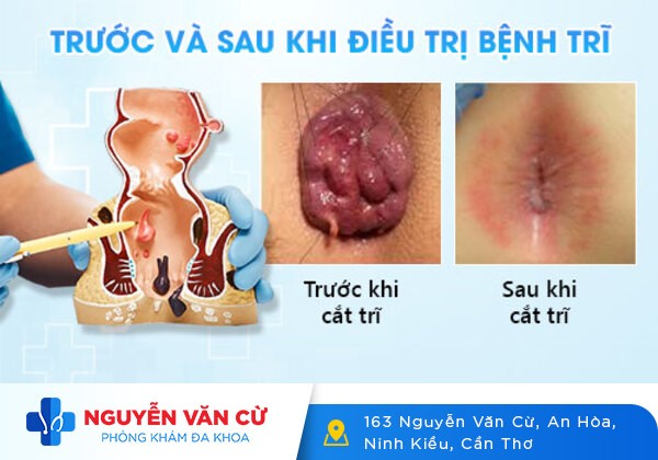 Chữa bệnh trĩ nội không còn là vấn đề khó