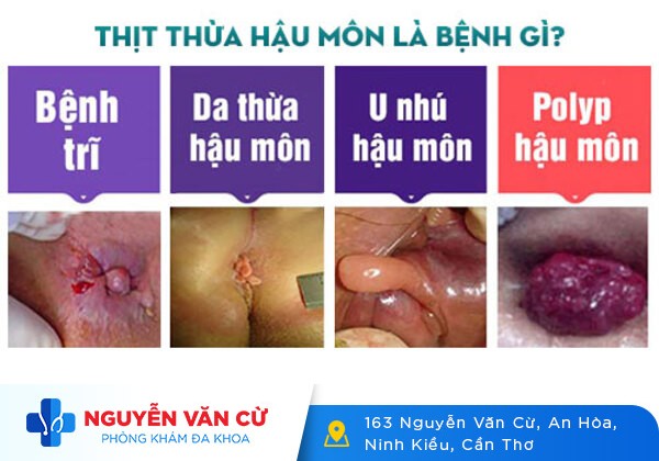 Hiện Tượng Cục Thịt Dư Lồi ra ở Hậu Môn Là Biểu Hiện Của Bệnh Gì?