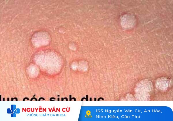 Dương vật nổi mụn trắng sau khi quan hệ có sao không?