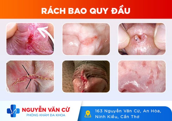Rách bao quy đầu – Nguyên nhân và cách điều trị?