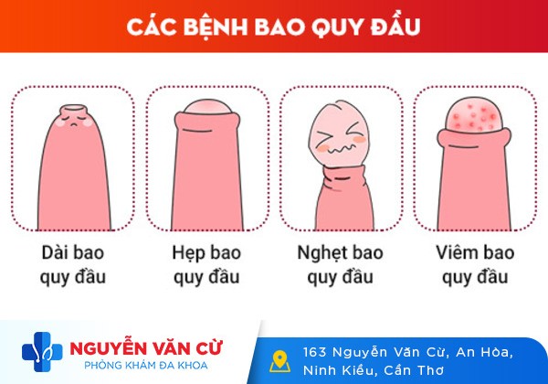 Các Bệnh Về Bao Quy Đầu – Chớ Dại Mà Xem Thường