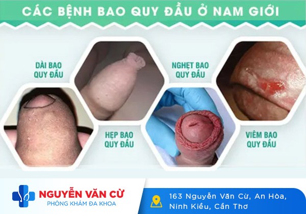 Các bệnh về bao quy đầu – chớ dại mà xem thường