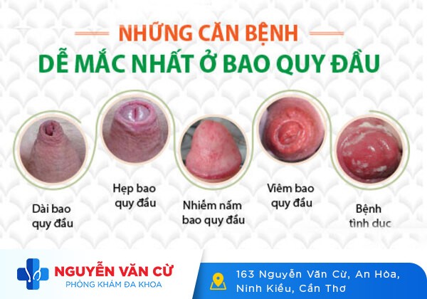 Chảy Máu Bao Quy Đầu Và Những Điều Cần Lưu Ý