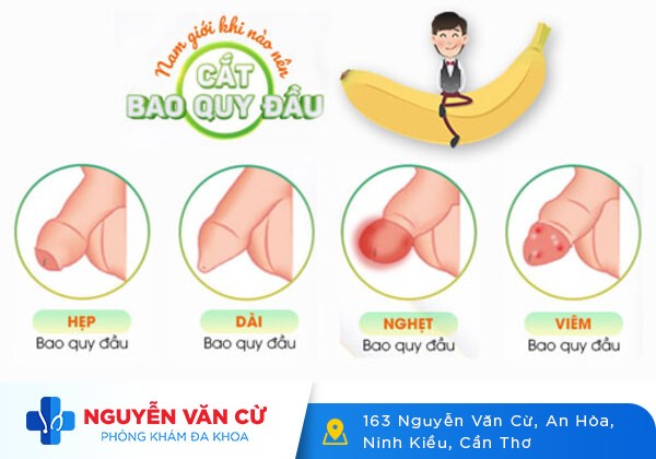 Cắt bao quy đầu và những điều có thể bạn chưa biết