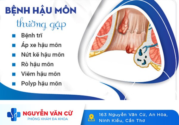 Ngứa hậu môn chữa ở đâu tốt tại Cần Thơ?