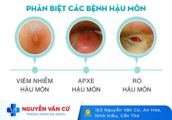 Chữa loét hậu môn trong 1 liệu trình