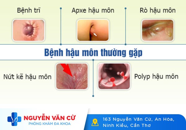Nóng rát hậu môn có sao không?