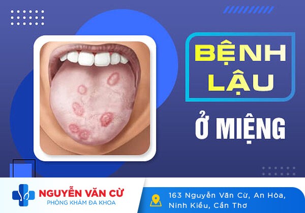 Bệnh lậu ở miệng và mối nguy hiểm ung thư vòng họng