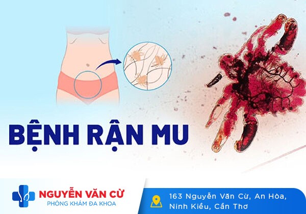 Thuốc trị rận mu loại nào tốt và hiệu quả?