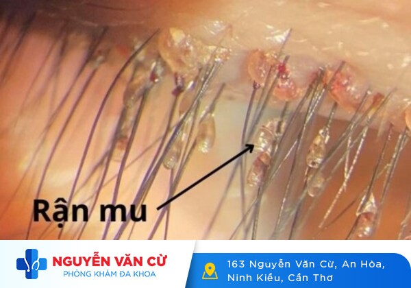 Những điều cần biết về bệnh rận mu