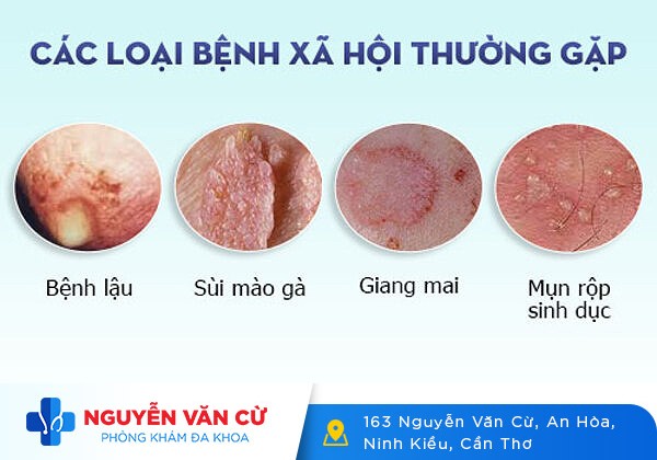 Bệnh lây qua đường tình dục – Chuyện không phải ai cũng biết