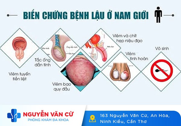 Nhận biết nhanh các dấu hiệu bệnh lậu ở nam giới