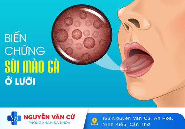 Sùi Mào Gà Ở Lưỡi – Nguyên Nhân Và Cách Điều Trị Hiệu Qủa