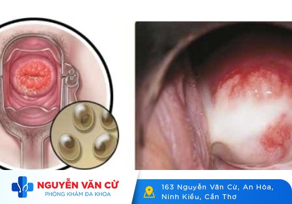 Chlamydia là gì? Có nguy hiểm không?