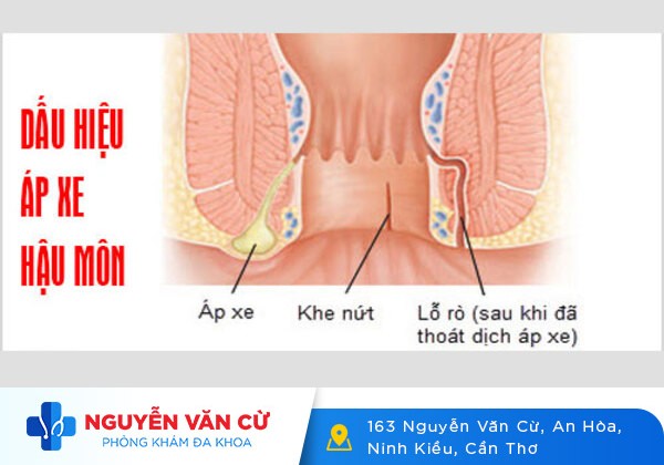 Đau rát hậu môn là biểu hiện của bệnh gì?