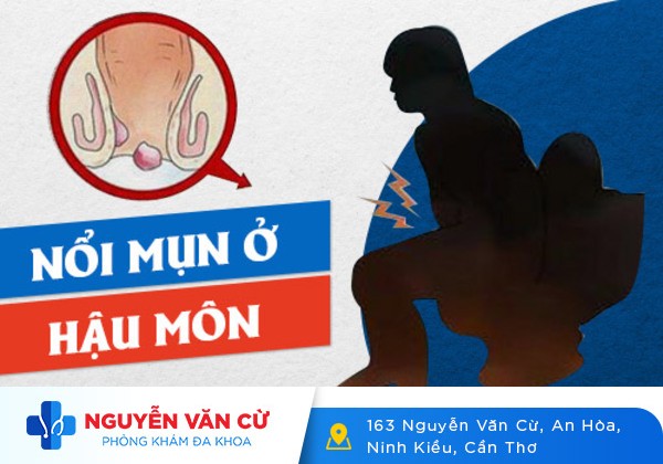 Nổi mụn nhọt ở hậu môn là dấu hiệu bệnh gì?