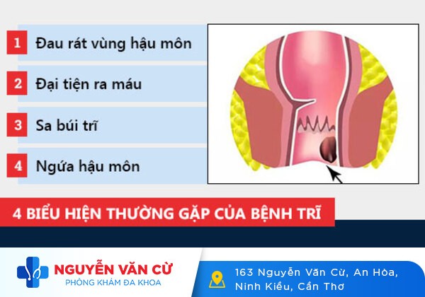 Bệnh trĩ nội có triệu chứng như thế nào?
