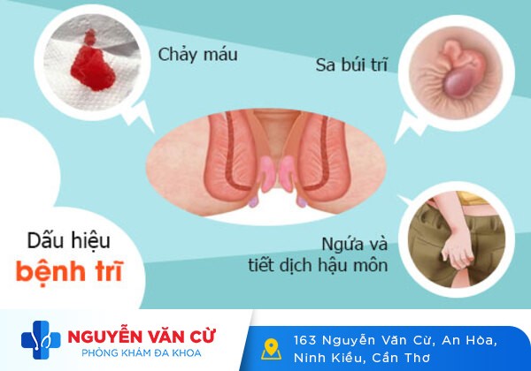 Hiện Tượng Sưng Hậu Môn Cảnh Báo Vấn Đề Gì Từ Cơ Thể?