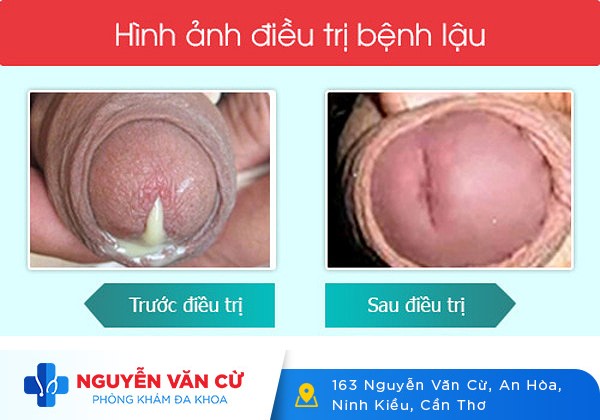 Triệu chứng bệnh lậu ở nam giới? Phải làm gì khi biết mình bị lậu?