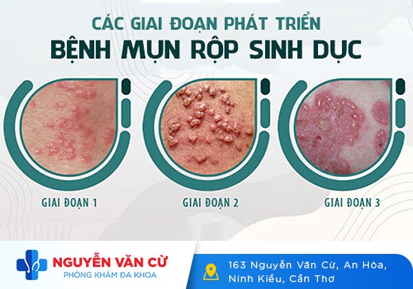Thông tin về herpes sinh dục