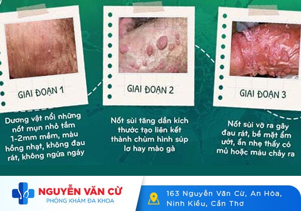 Dương Vật Nổi Mụn Trắng Là Bệnh Gì? Cách Khắc Phục